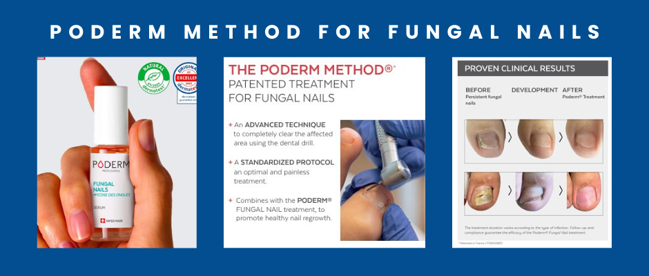 poderm method for fungal nails
