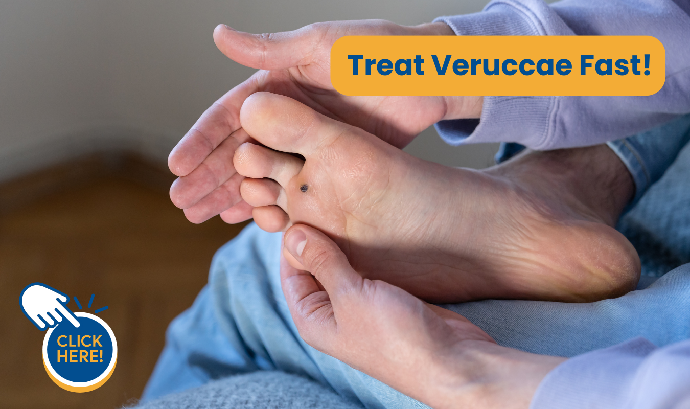 treat verrucae fast