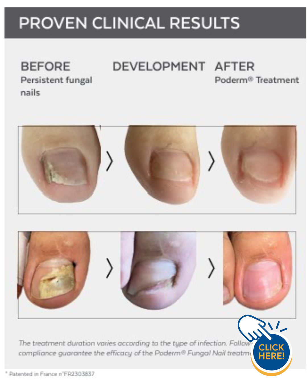 poderm for fungal nails