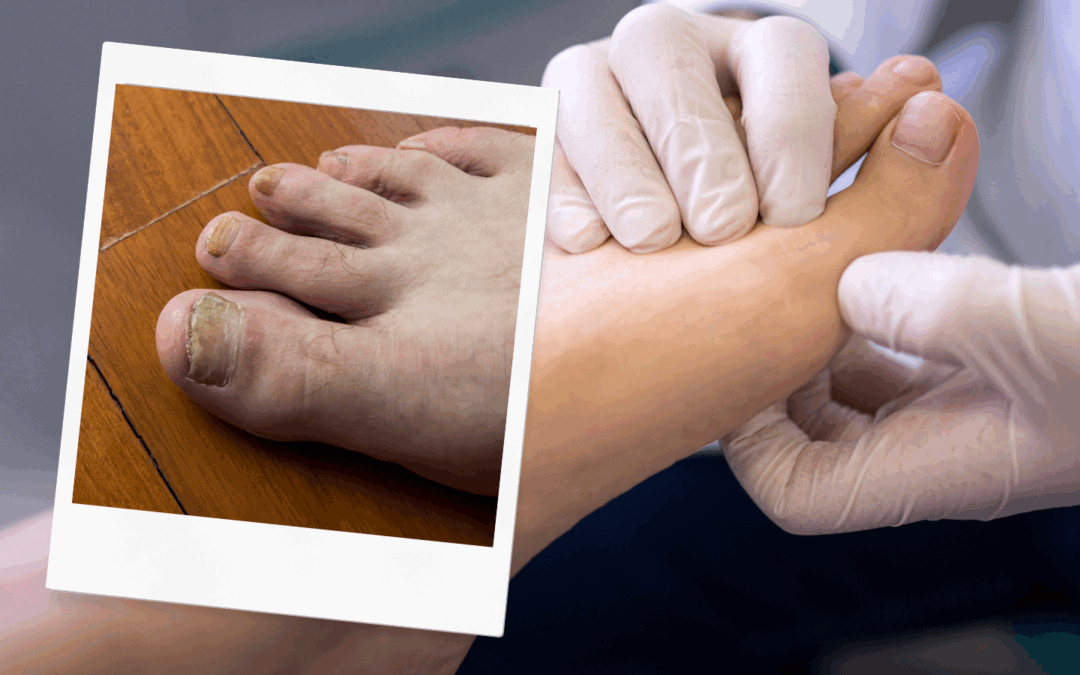 How to Prevent Fungal Nails: Simple Foot Care Tips from a Cambridge Podiatrist