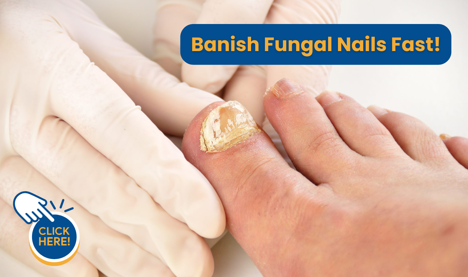 treat fungal nails