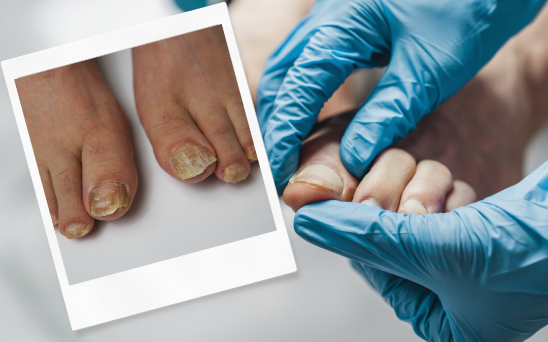 treat fungal nails early