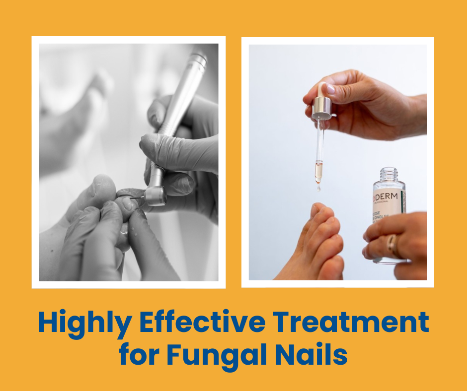 fungal nail treatment in cambridge