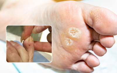 Corn vs Callus: What’s the Difference and Does It Matter?